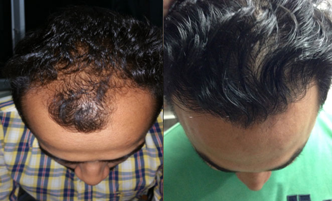 hair transplant