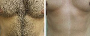 body hair transplant