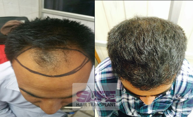 Hair Transplant Cost in Patiala