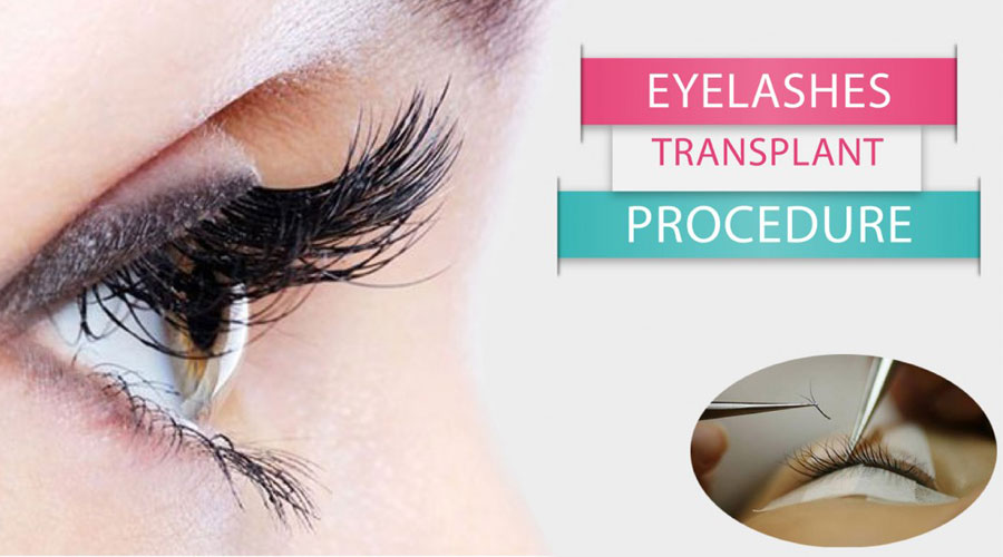 eyelash-transplant